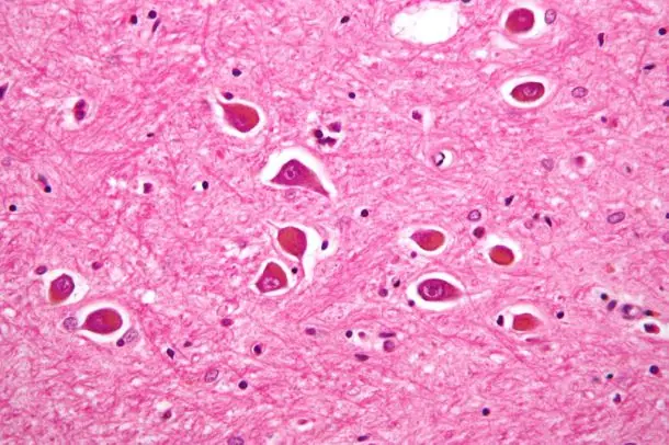 ALZHEIMER