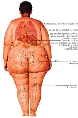 Tratamiento de obesidad.adelgazar sanamente
