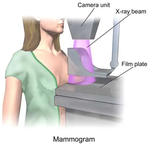 Las Mamografías Causan Cáncer de Mama (Alternativas)