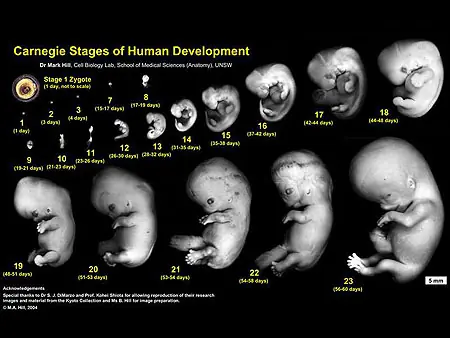 aborto