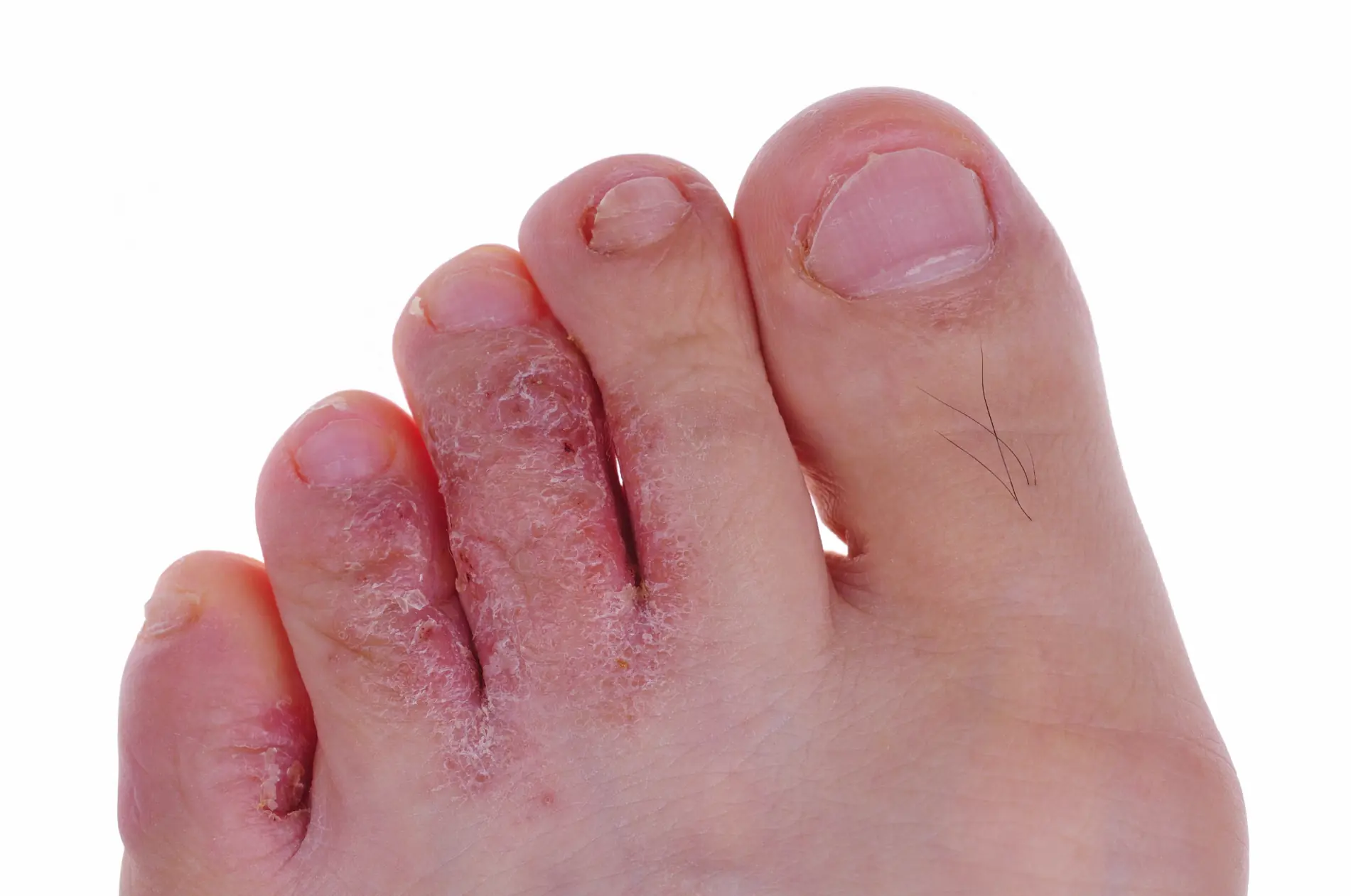 Lince, Sacale provecho al Vick Vaporub