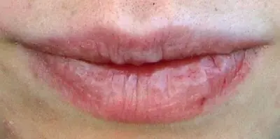 labios