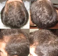 Minoxidil, mi experiencia