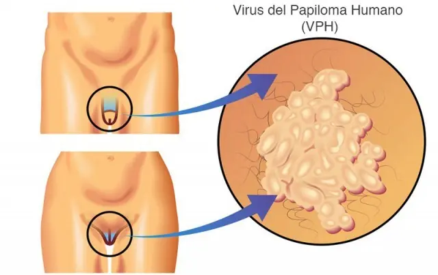 virus
