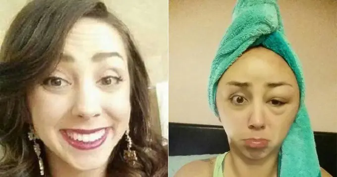 Una mujer quedó deforme por teñirse el pelo