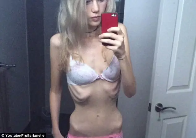 ANOREXIA ANOREXIA