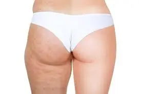Celulitis