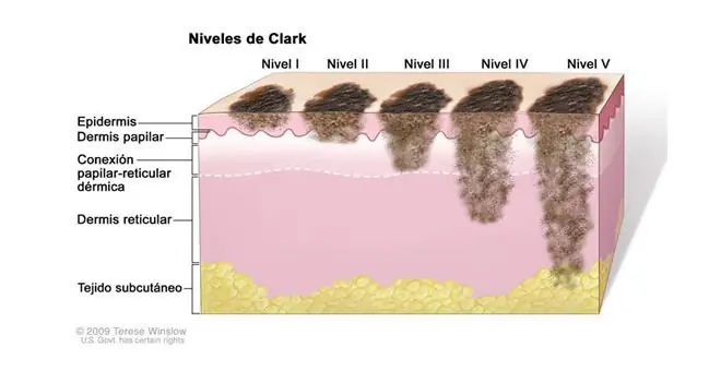 Imagen que podría Salvarte, Saber si tu Lunar es Canceroso