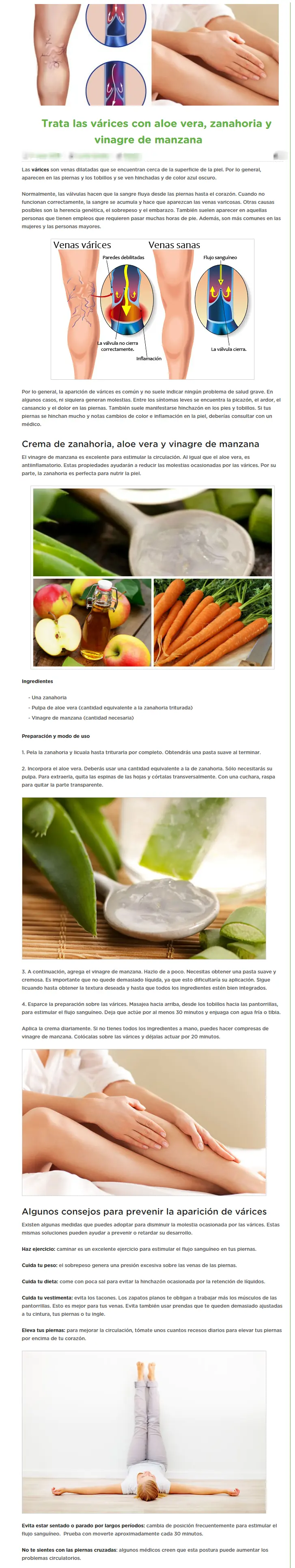 Trata las várices con aloe vera, zanahoria , vinagre