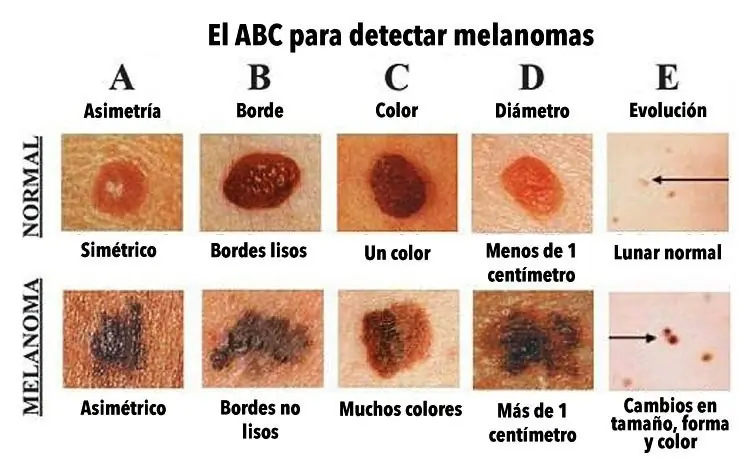 Imagen que podría Salvarte, Saber si tu Lunar es Canceroso