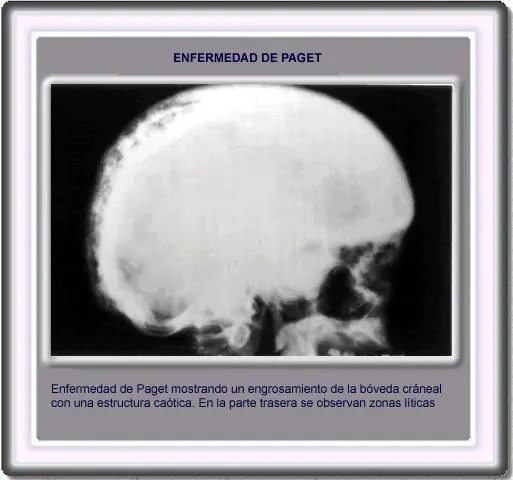 Enfermedad de Paget, [Inteligencia Colectiva]