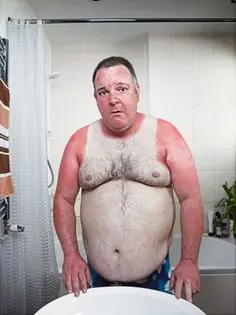 La Moda del Verano: Quemarse apropósito (Sin Palabras...)