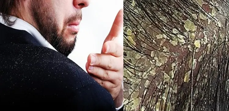 Eliminar la caspa con productos naturales