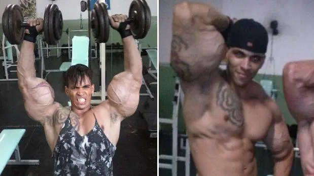 Casi pierde los brazos por parecerse a Hulk