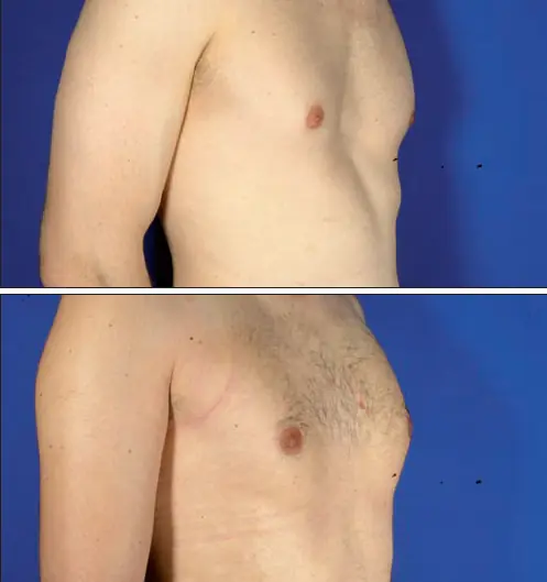 Pectus