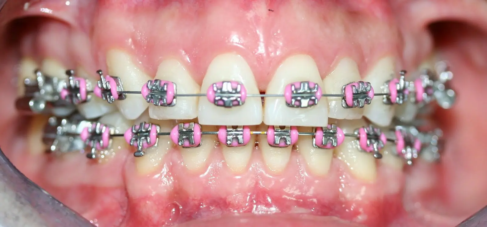 dientes