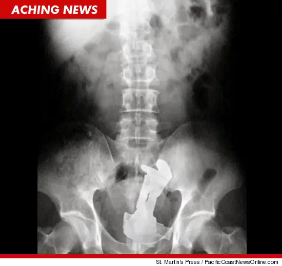Una persona se metio un Buzz Lightyear en el ano..