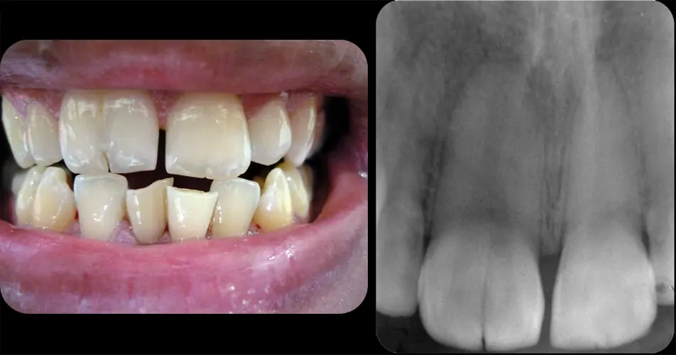 8 Datos sobre tus dientes algo traumáticos.