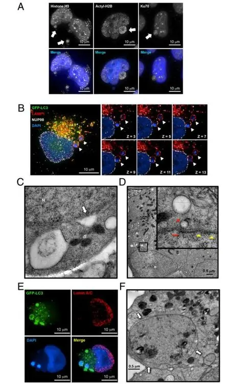 Crean fármaco que mata de hambre a las células cancerosas