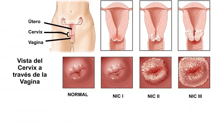 Virus del papiloma humano, Mujer entra.