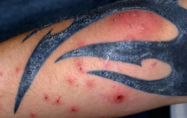 El peligro detrás de los tatuajes