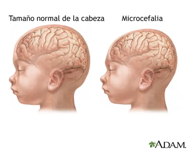 aborto aborto