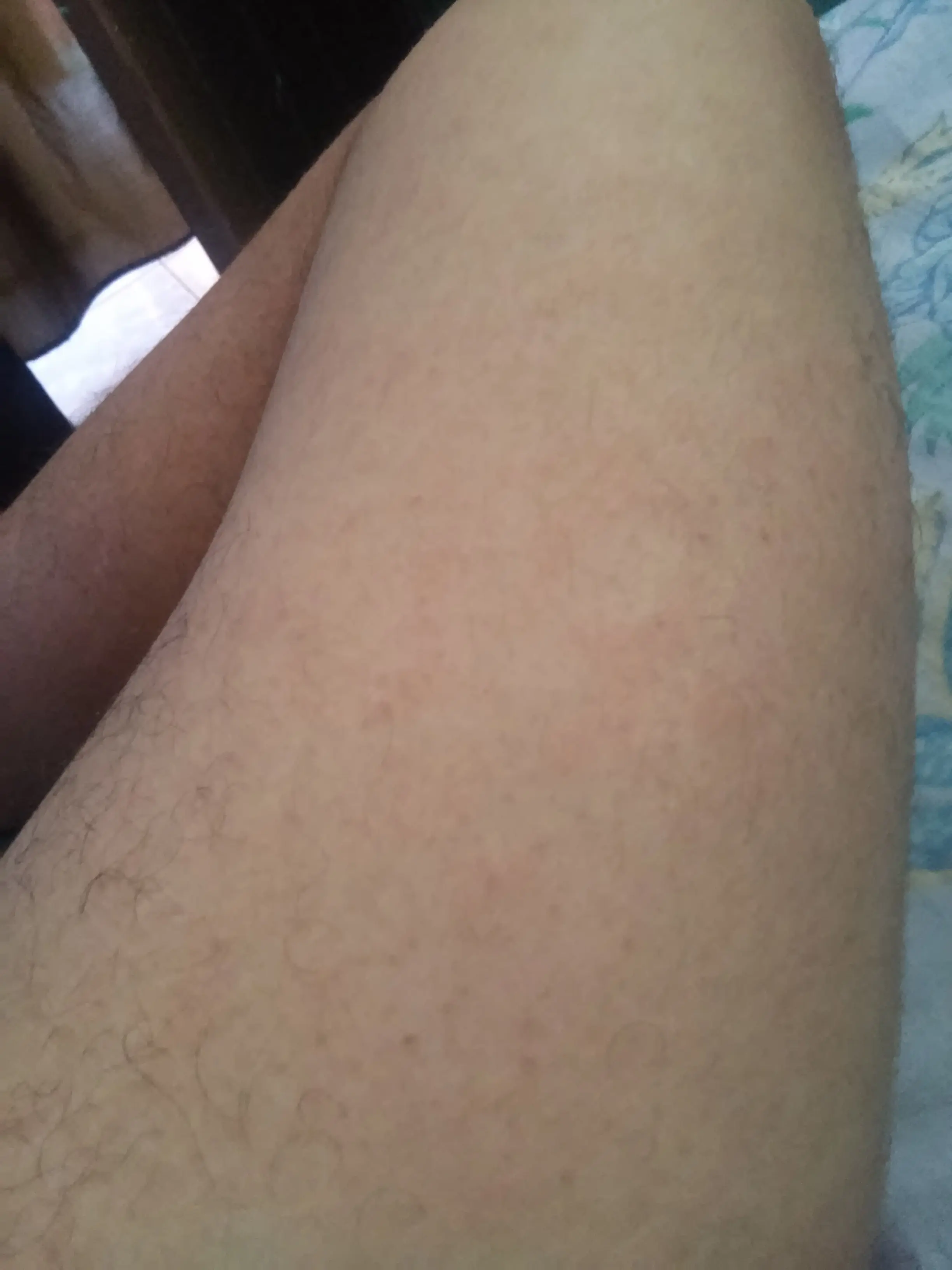 chikungunya