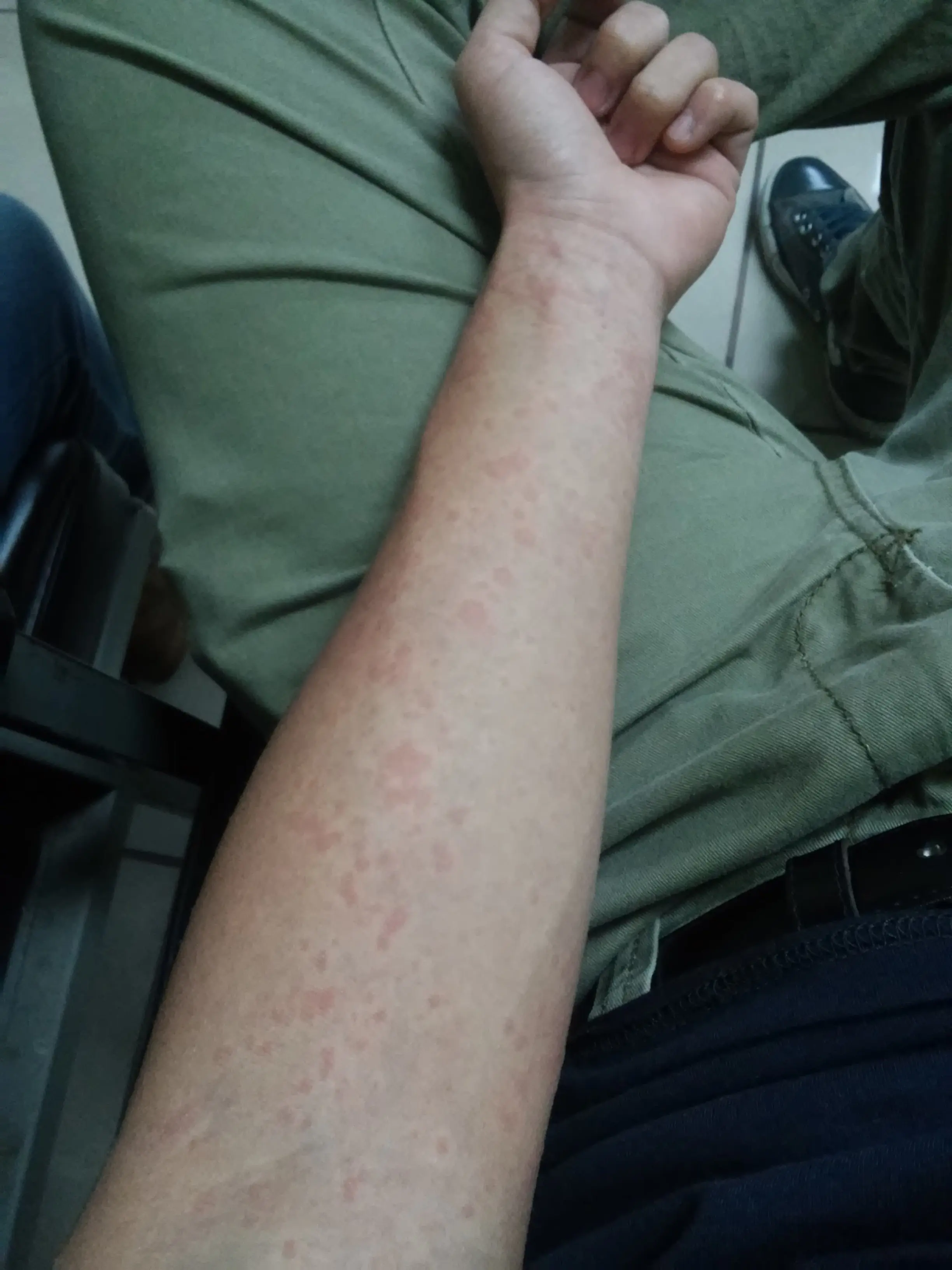 chikungunya