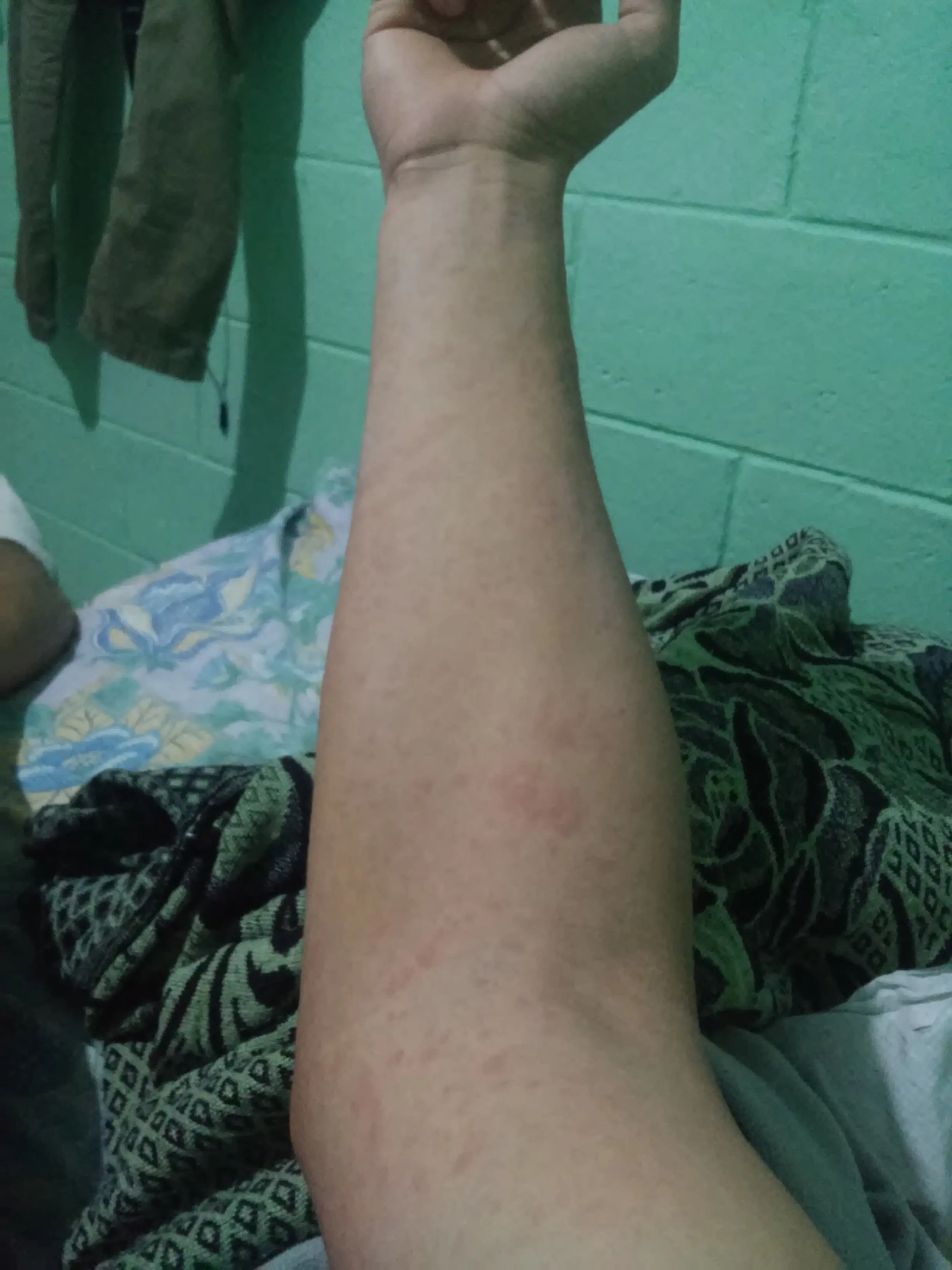 Me dio chikungunya y te lo muestro [fotos]