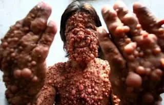 sindrome de