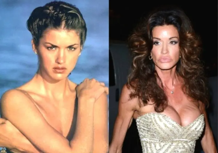 Cirugía plástica de los famosos: el antes y el después