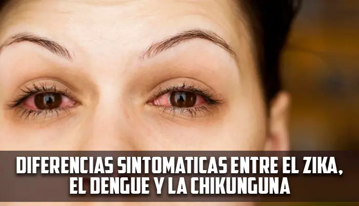 microcefalia microcefalia