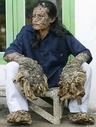 el hombre árbol