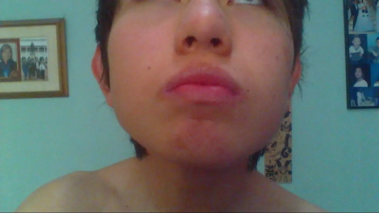 Tratamiento con Isoface 20Mg (Mes a Mes)