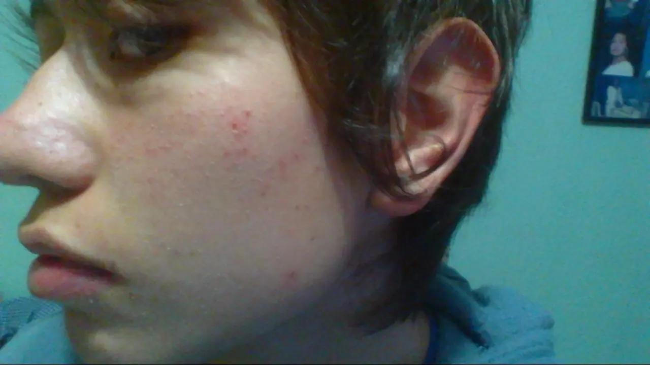 acne quistico