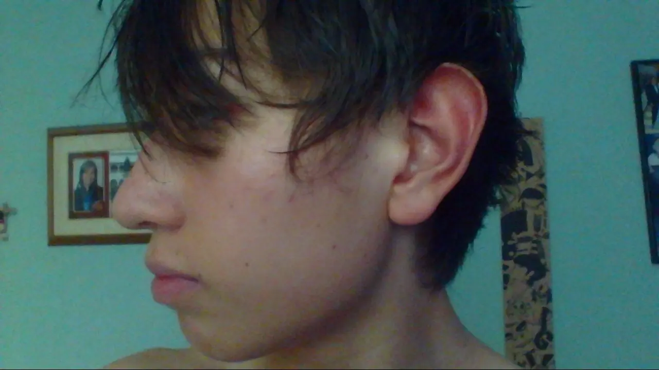 acne vulgar