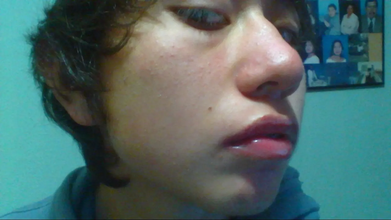 acne solucion definitiva