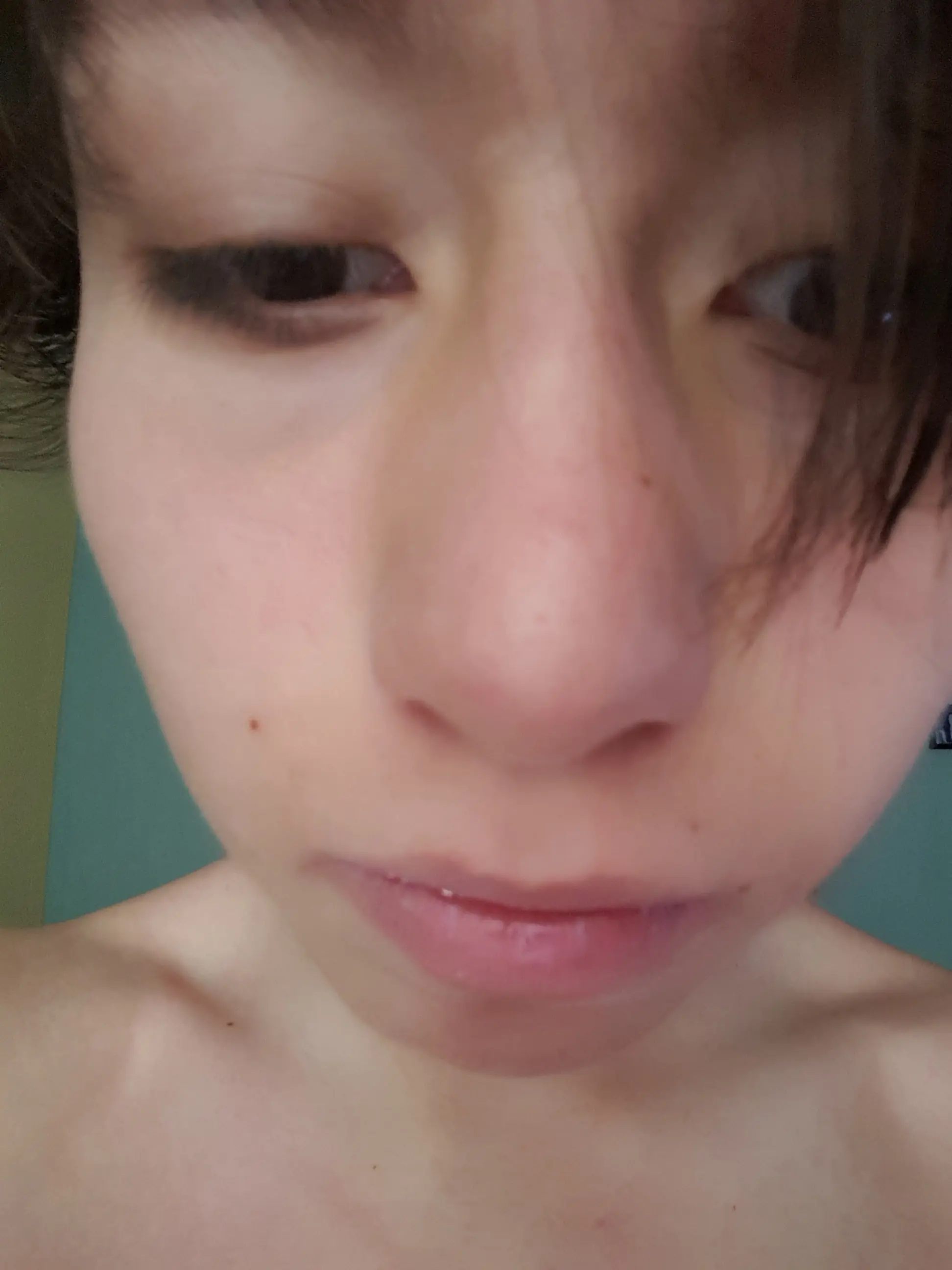 isotretinoina para el acne