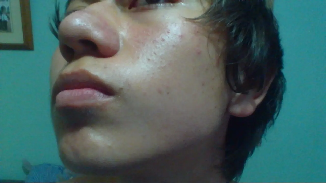 acne severo
