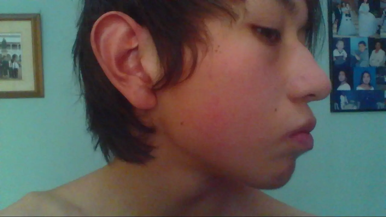 adios acne
