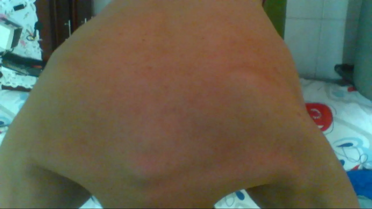 acne quistico