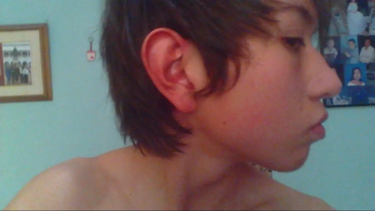 acne solucion definitiva
