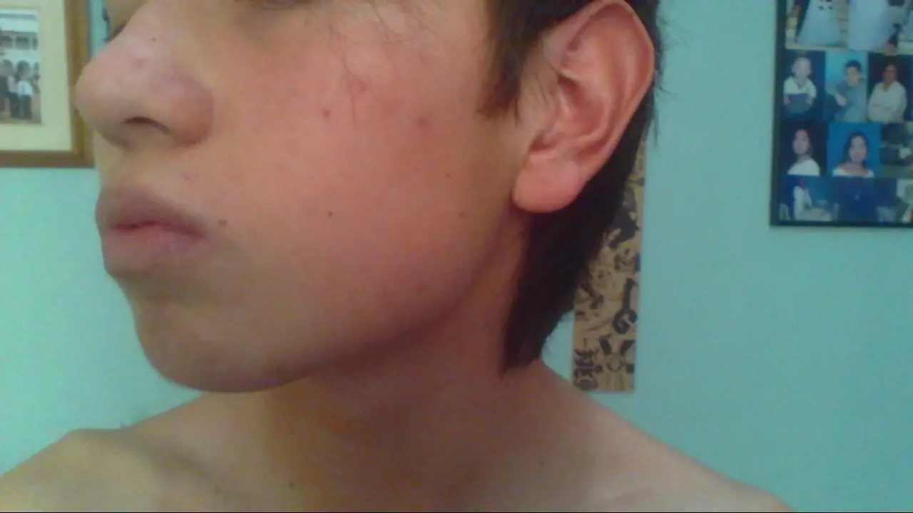 acne soluciones