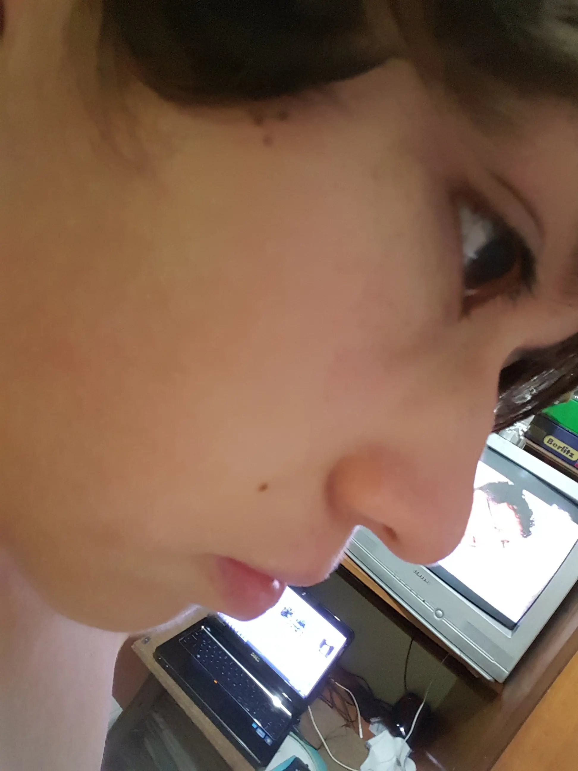 adios acne
