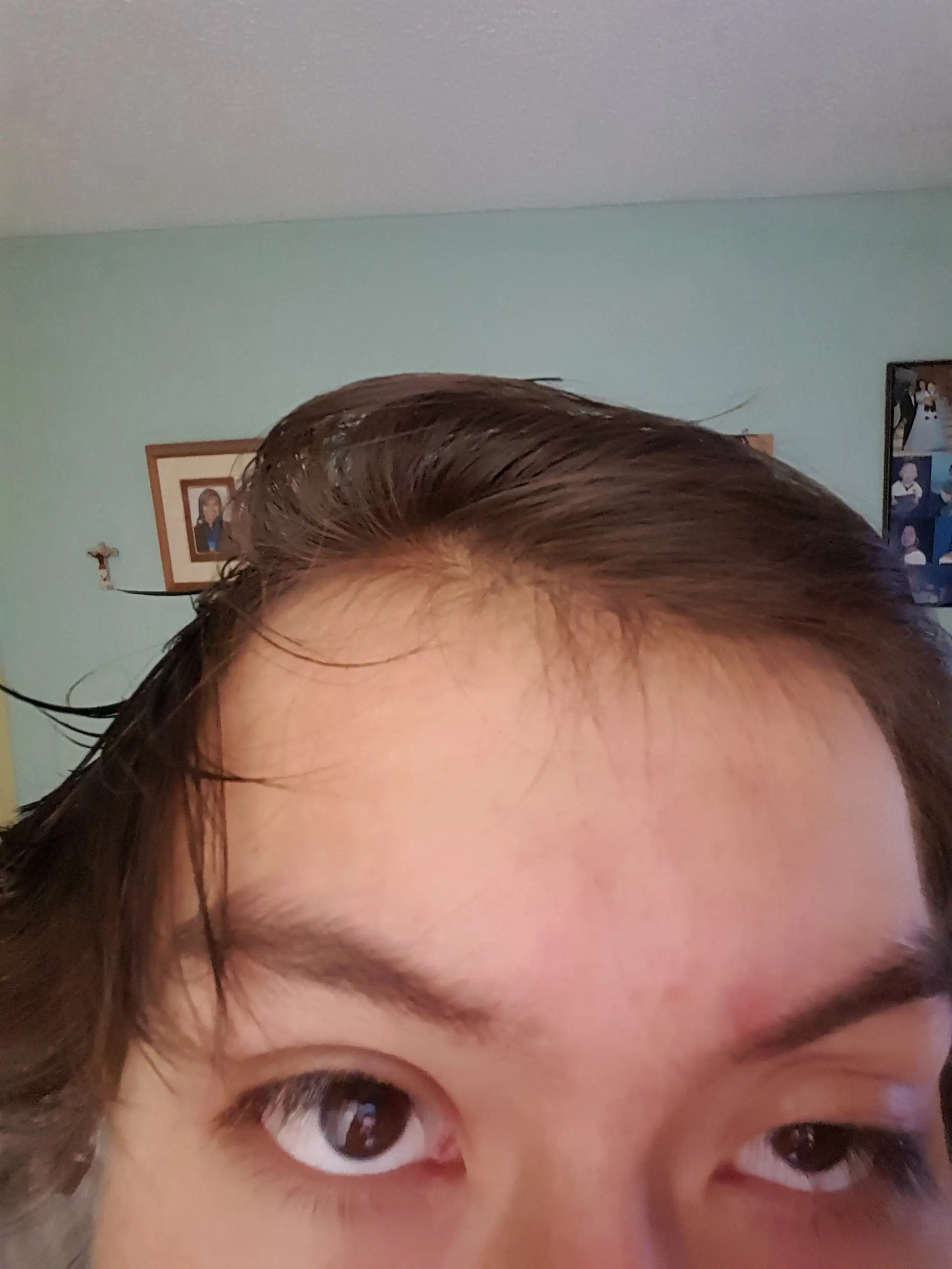 acne solucion definitiva