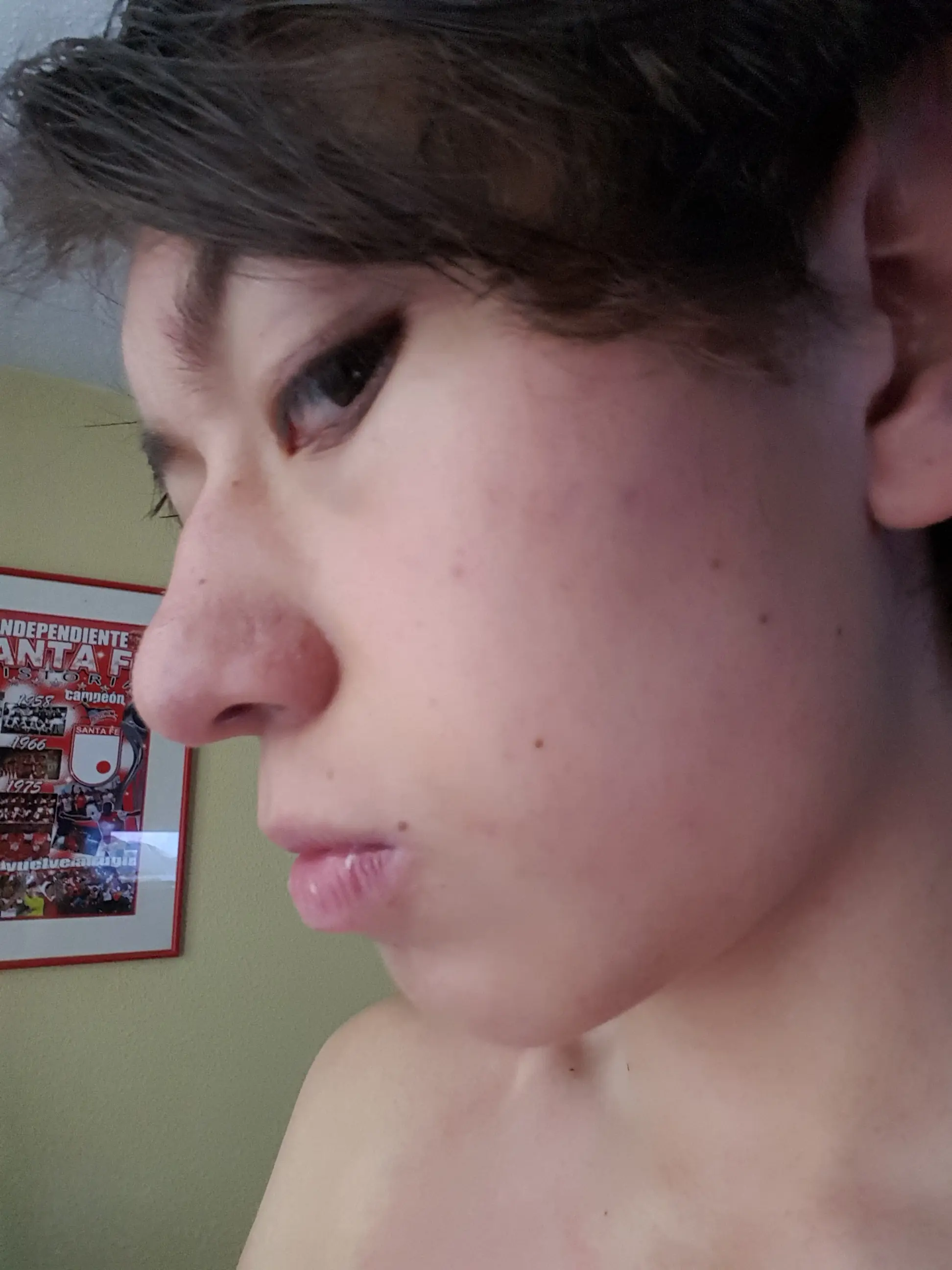 acne soluciones