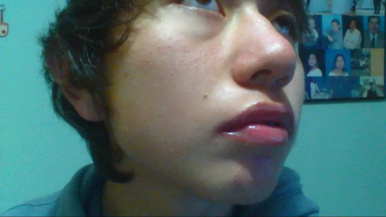 isotretinoina para el acne