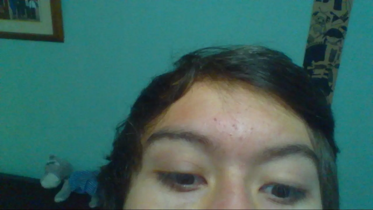 adios acne