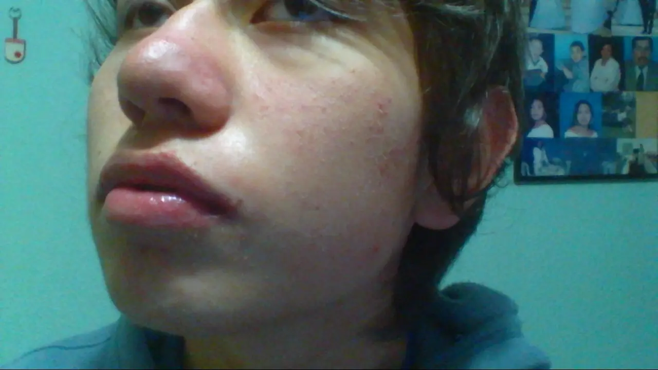 Tratamiento con Isoface 20Mg (Mes a Mes)