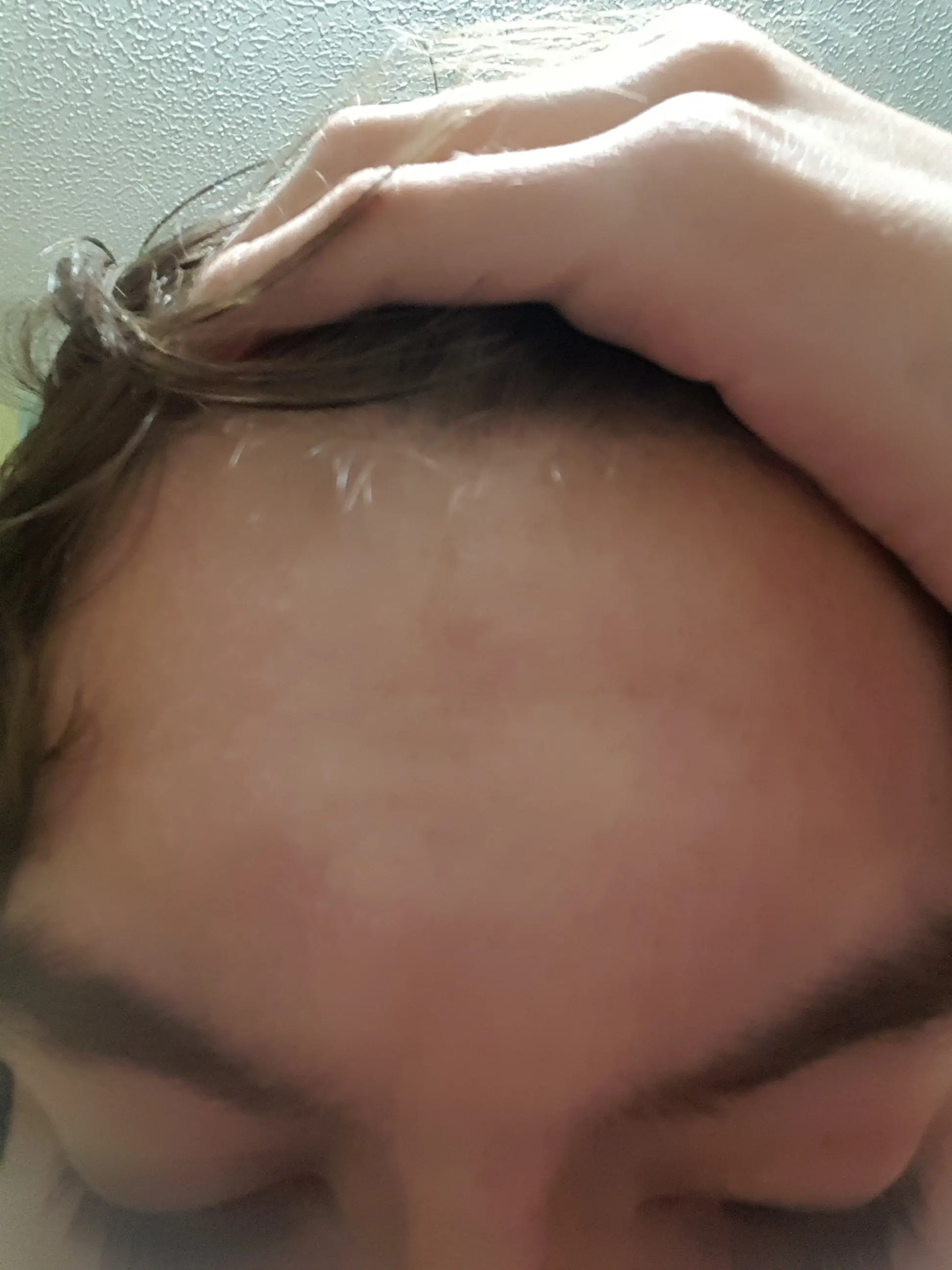 Tratamiento con Isoface 20Mg (Mes a Mes)